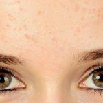 Bruntus on the forehead