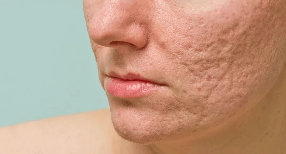 Berapa Kali Treatment untuk Menghilangkan Bopeng?