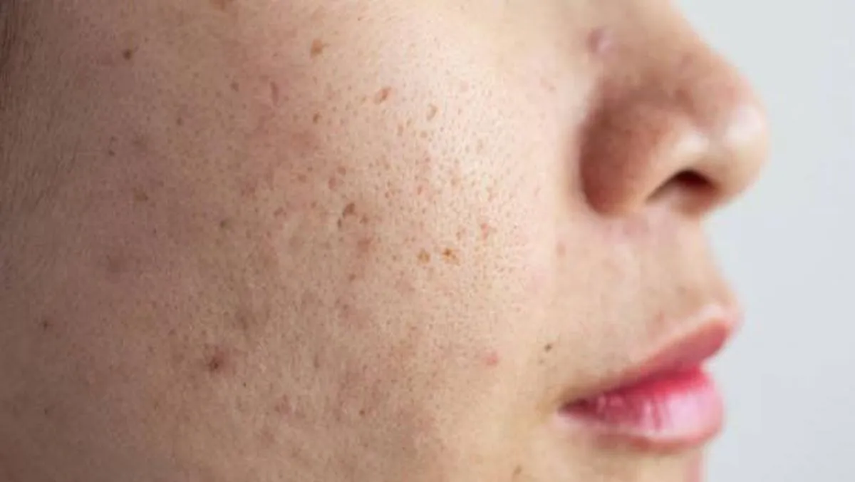 Cara Menghilangkan Lubang Bekas Jerawat Dengan Cepat dan Ampuh