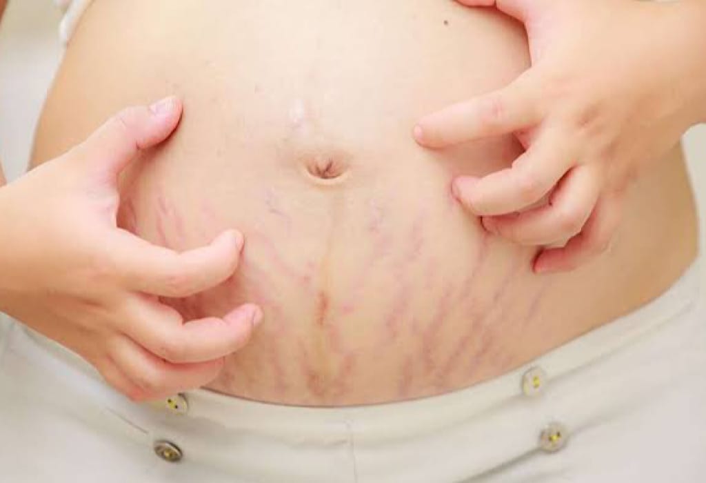 Stretch Mark Ibu Hamil