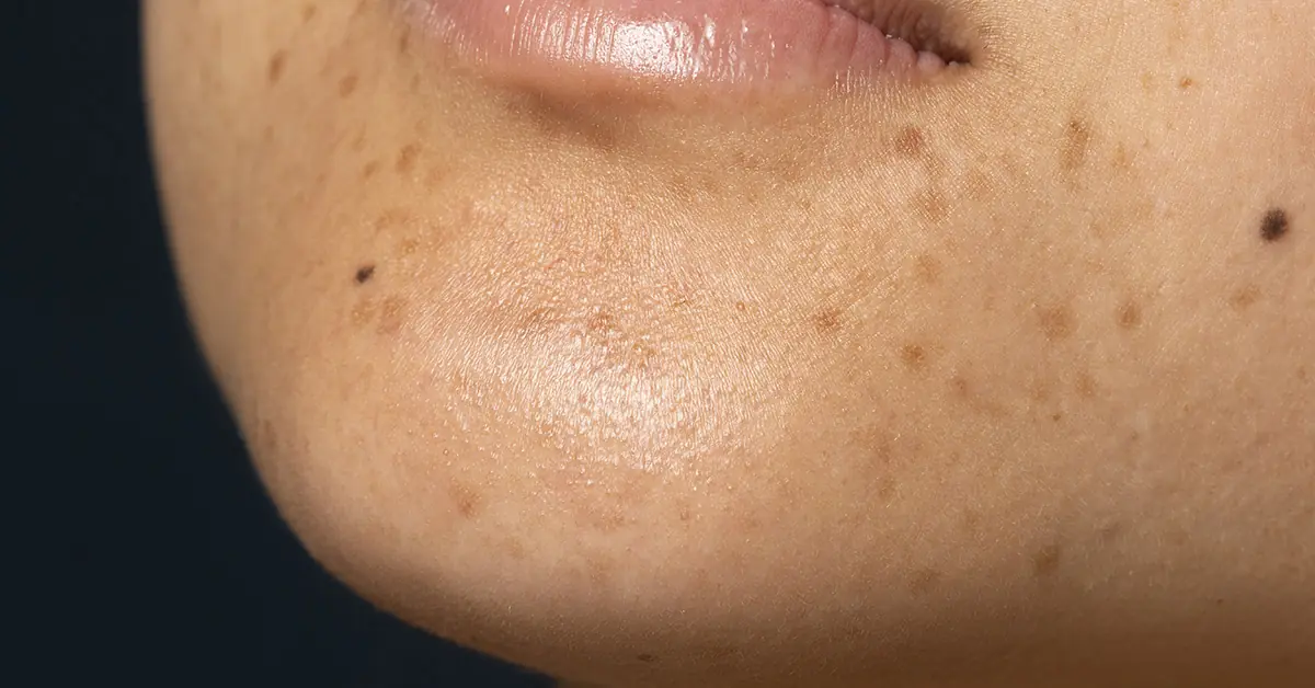 Perbedaan Flek Hitam dan Melasma