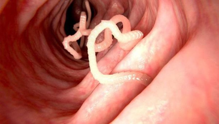 Mengeluarkan Cacing Kremi dari Dubur