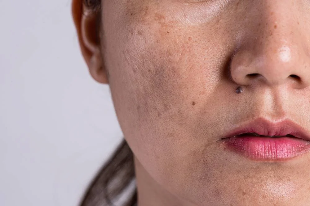 Dull Skin Adalah: Penyebab, Cara Mengatasinya, dan Tips Kulit Cerah