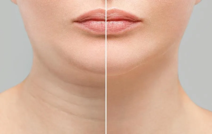 Cara Menghilangkan Lemak di Leher