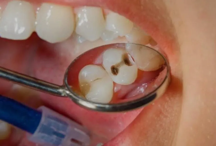 Menghilangkan Hitam di Gigi