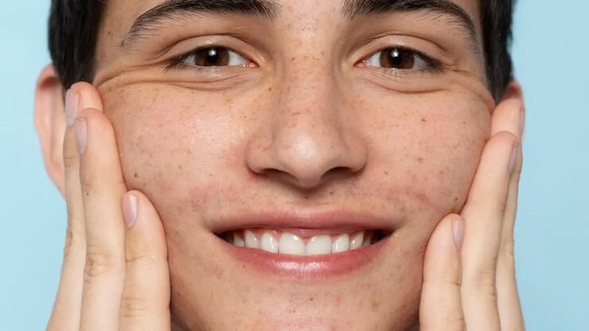 Cara Menghilangkan Biang Keringat di Wajah