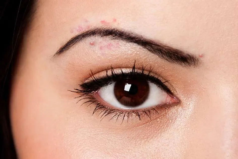 Penyebab Jerawat di Alis