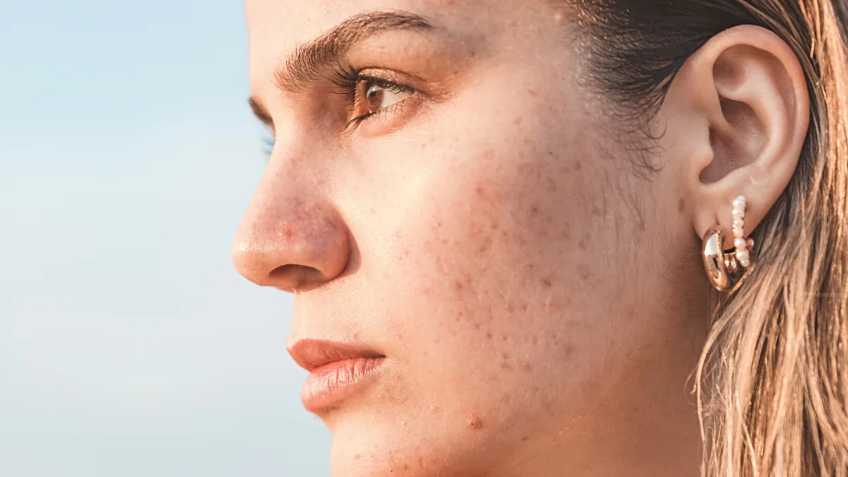 Wajah Beruntusan dan Gatal