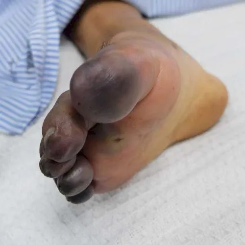 Ciri-Ciri Penyakit Gula Magnumtogel