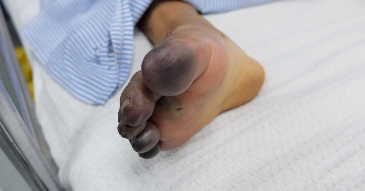 Ciri-Ciri Penyakit Gula Magnumtogel