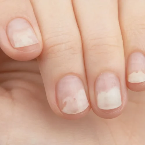 Contoh kuku yang tidak sehat bisa jadi tanda tubuh kamu sedang bermasalah. Yuk kenali cirinya dan cara mencegahnya agar kuku tetap kuat dan cantik!