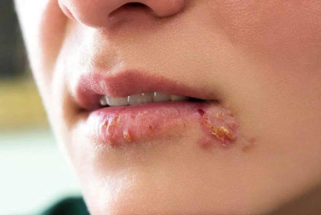 jerawat herpes