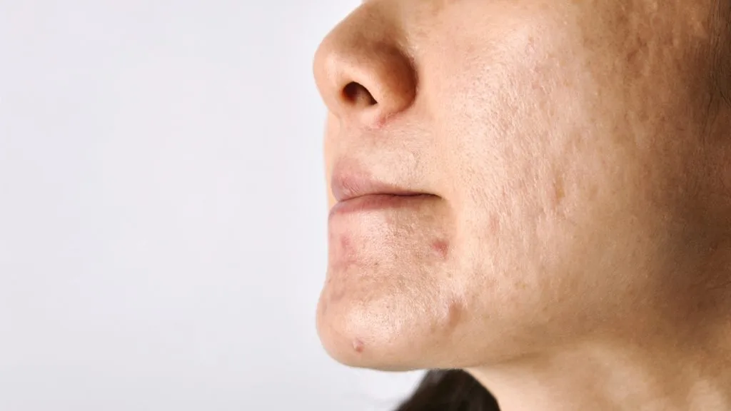 kenapa habis facial malah jerawatan