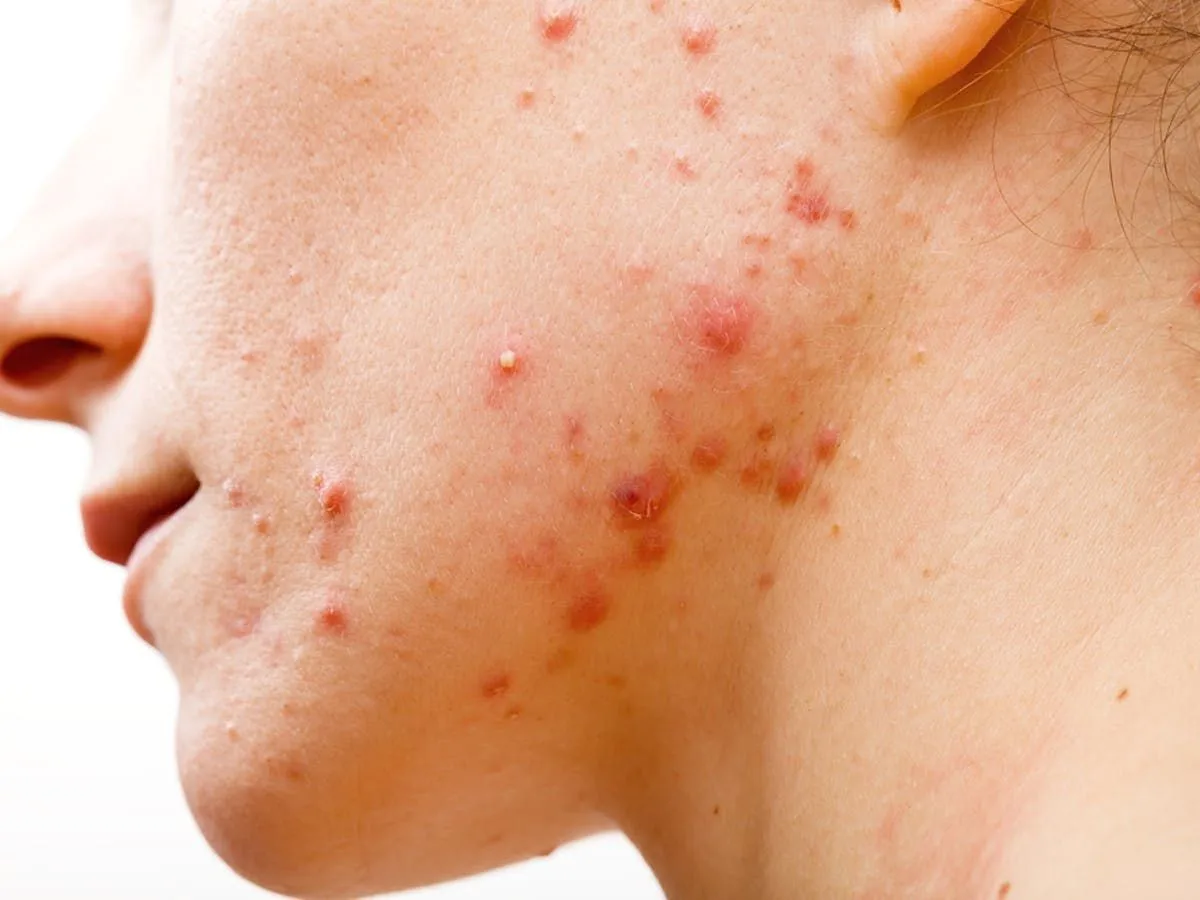 mitos atau fakta makan kacang bikin jerawatan