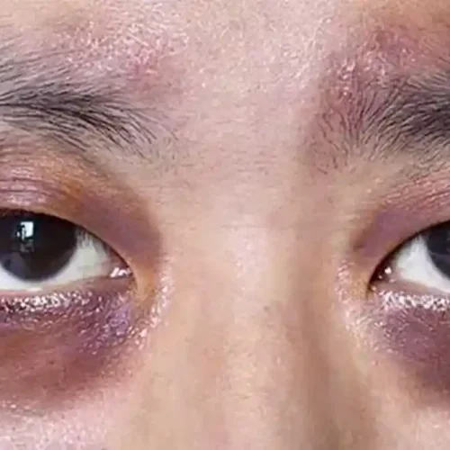 perawatan mata panda di klinik kecantikan