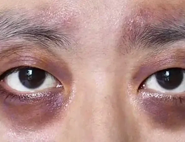 perawatan mata panda di klinik kecantikan