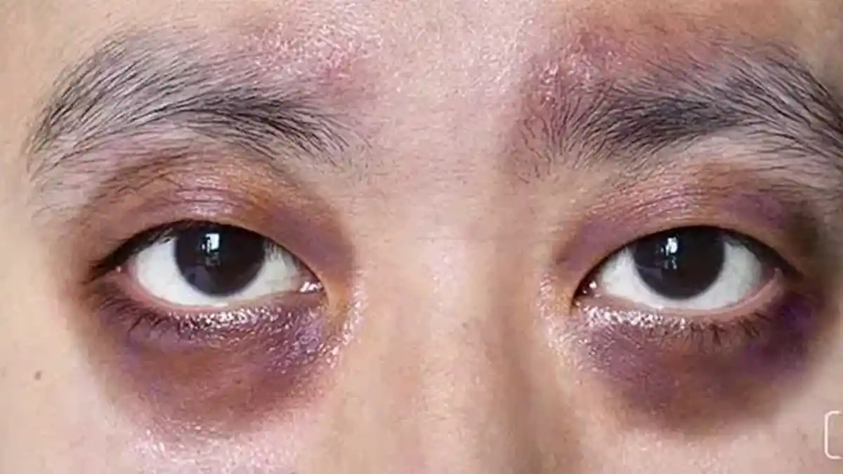 perawatan mata panda di klinik kecantikan