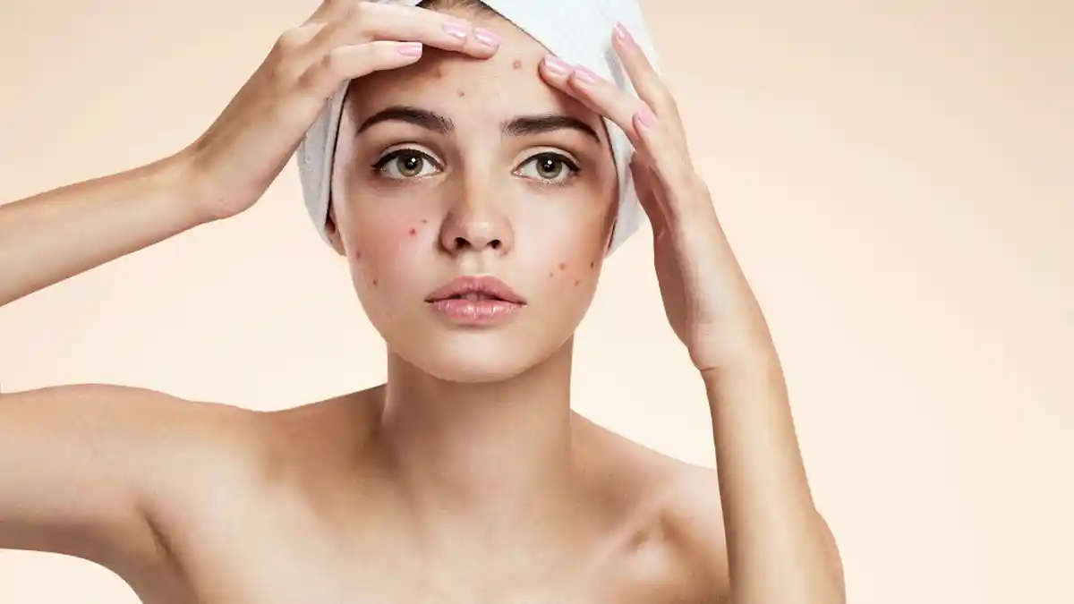 probiotik untuk jerawat