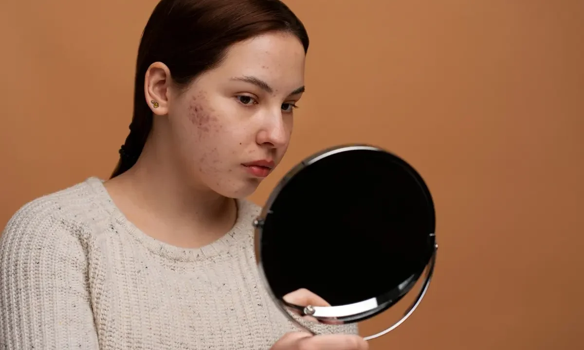Perbedaan Fungal Acne dan Bruntusan yang Sering Bikin Bingung, Kamu Sudah Tahu Belum?