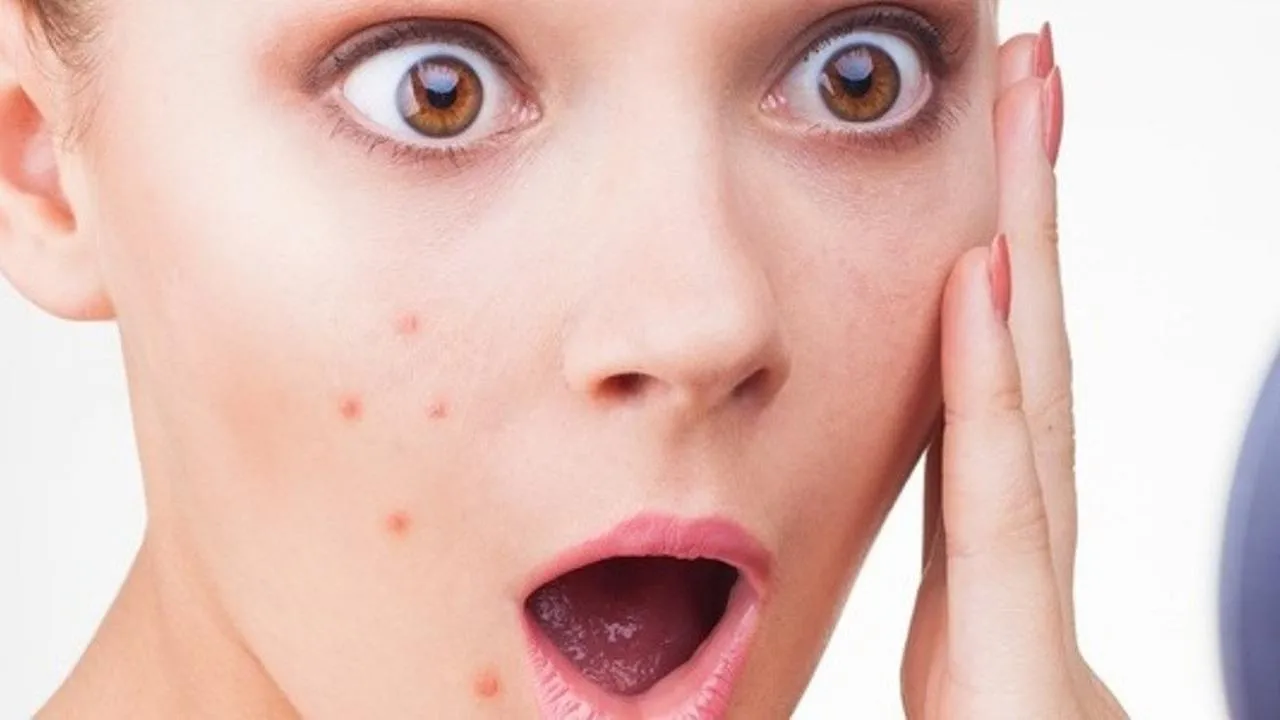 cara menstabilkan hormon penyebab jerawat