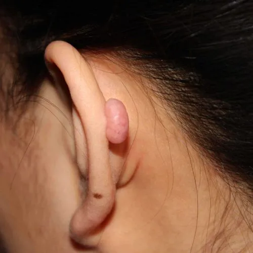 biaya operasi keloid