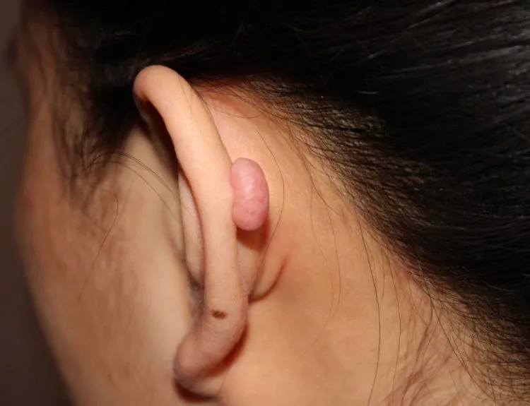 biaya operasi keloid