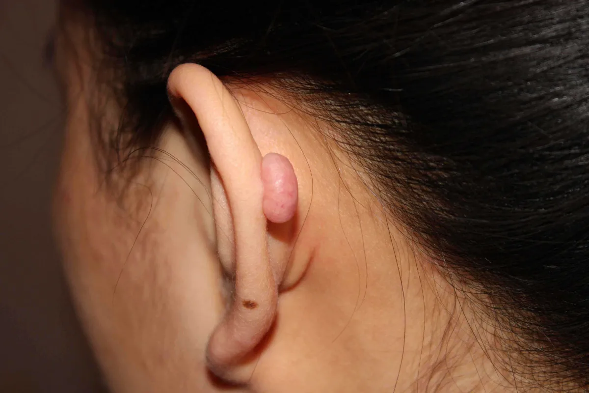 biaya operasi keloid