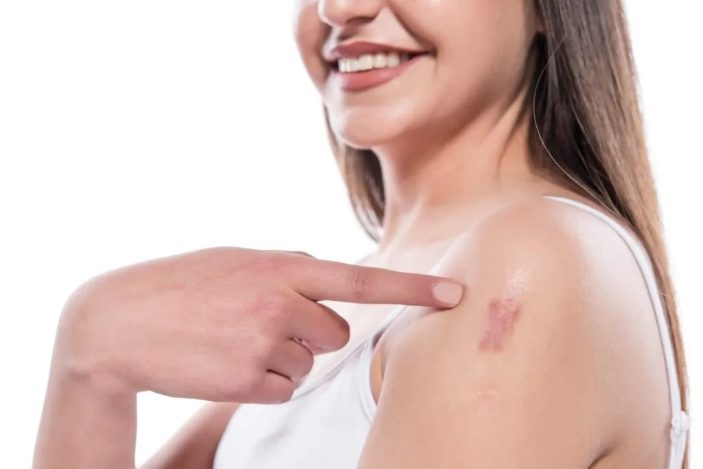 biaya operasi keloid