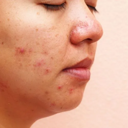 cara mengatasi jerawat kistik