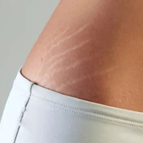 cara ampuh menghilangkan stretch mark setelah melahirkan