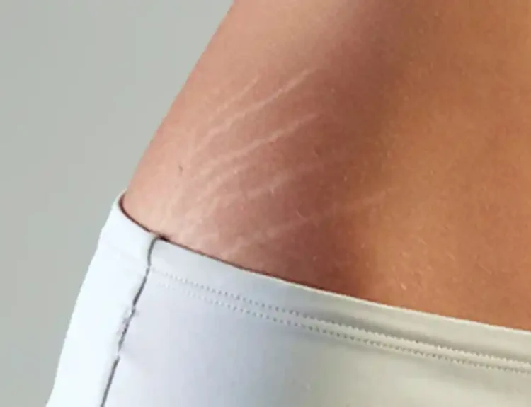 cara ampuh menghilangkan stretch mark setelah melahirkan