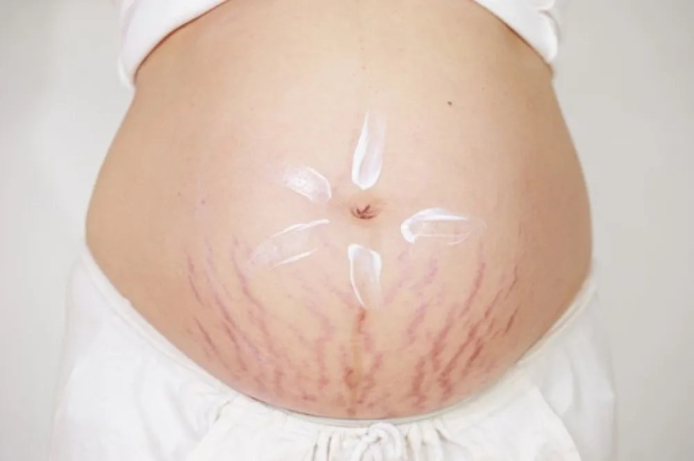 cara ampuh menghilangkan stretch mark setelah melahirkan