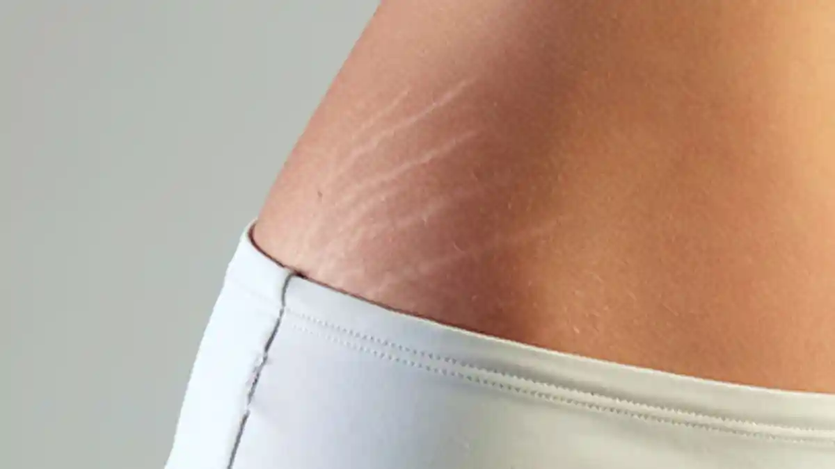 cara ampuh menghilangkan stretch mark setelah melahirkan