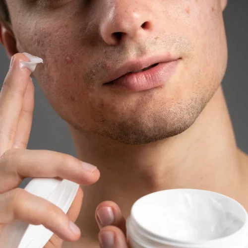 obat jerawat nodul di apotik