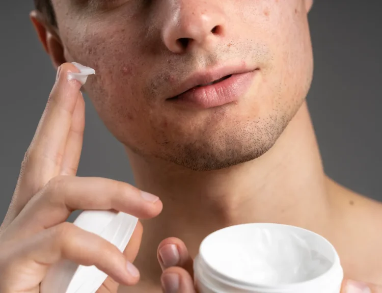 obat jerawat nodul di apotik