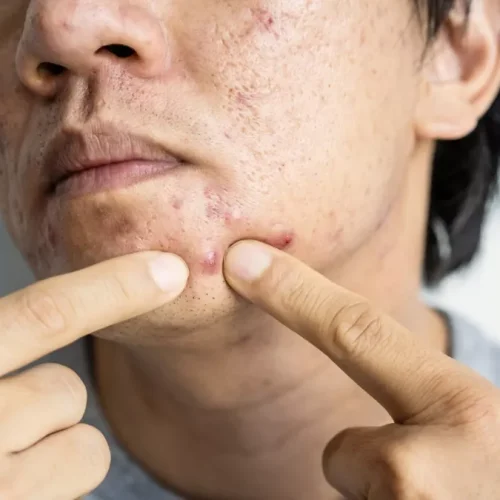 cara mengempeskan jerawat yang bengkak