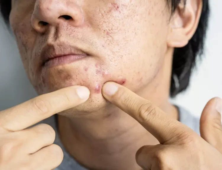 cara mengempeskan jerawat yang bengkak