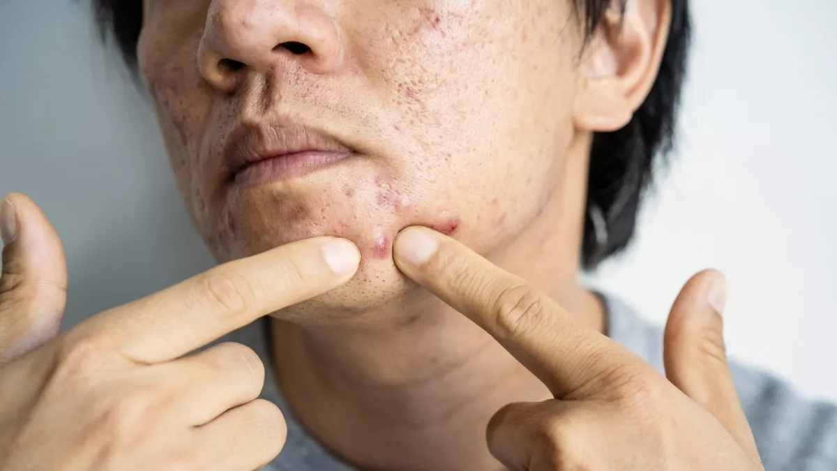 cara mengempeskan jerawat yang bengkak