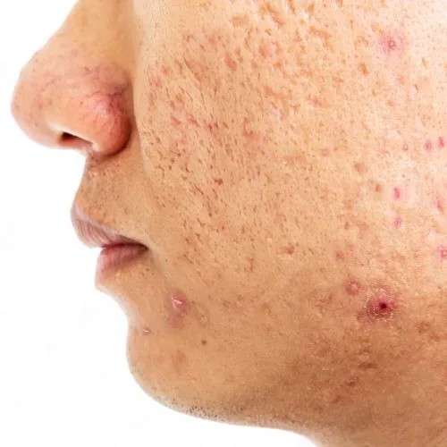 cara menghaluskan wajah bekas jerawat