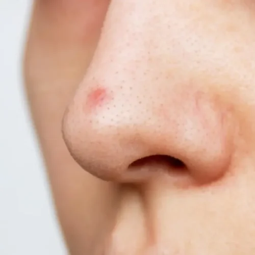 cara mengobati jerawat di hidung
