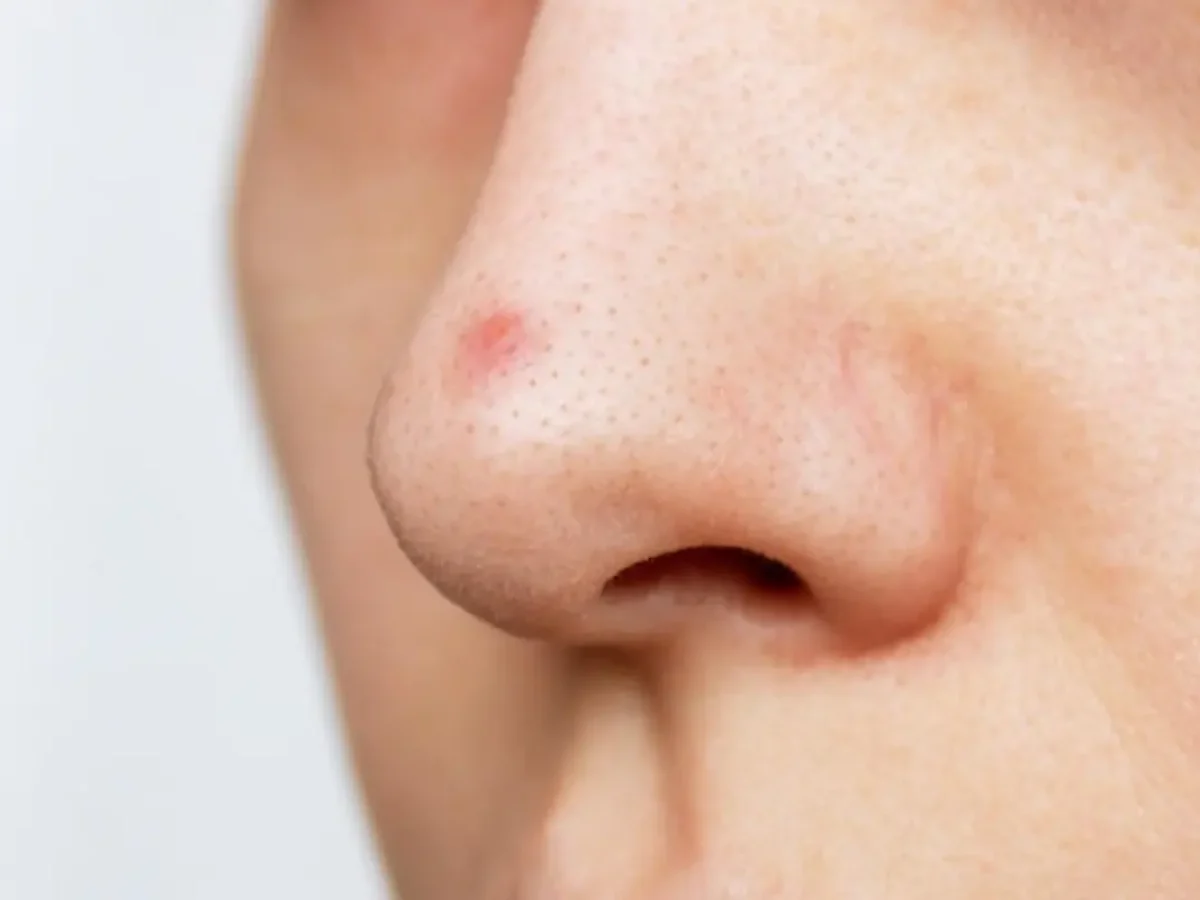 cara mengobati jerawat di hidung