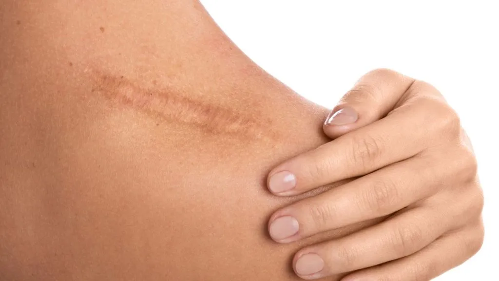 cara menghilangkan keloid secara alami