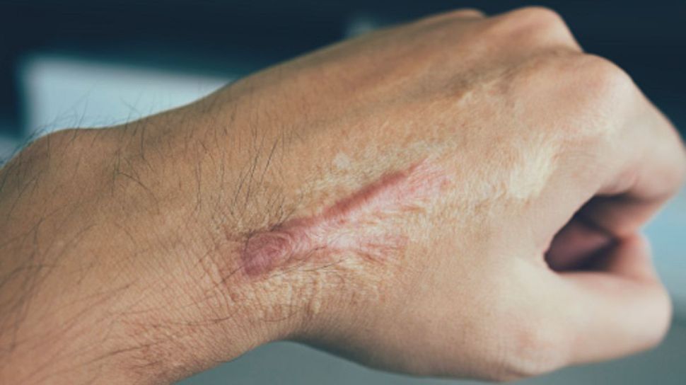 cara menghilangkan keloid secara alami