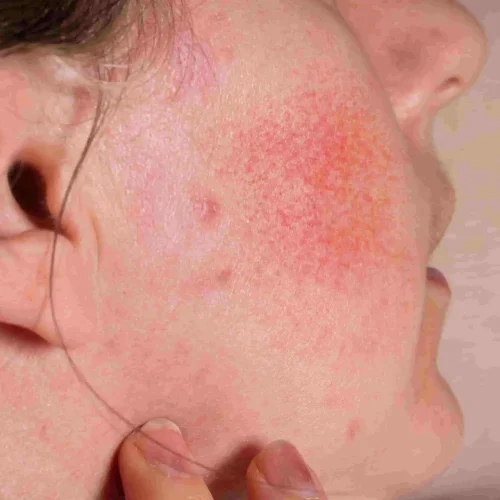 redness adalah