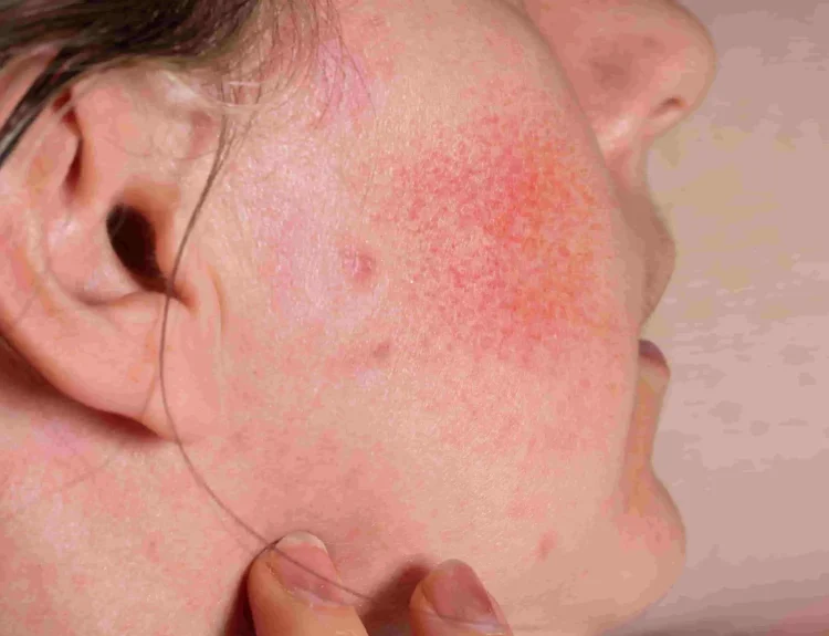 redness adalah