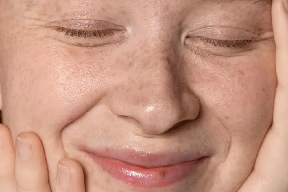 cara menghilangkan kerutan di samping hidung