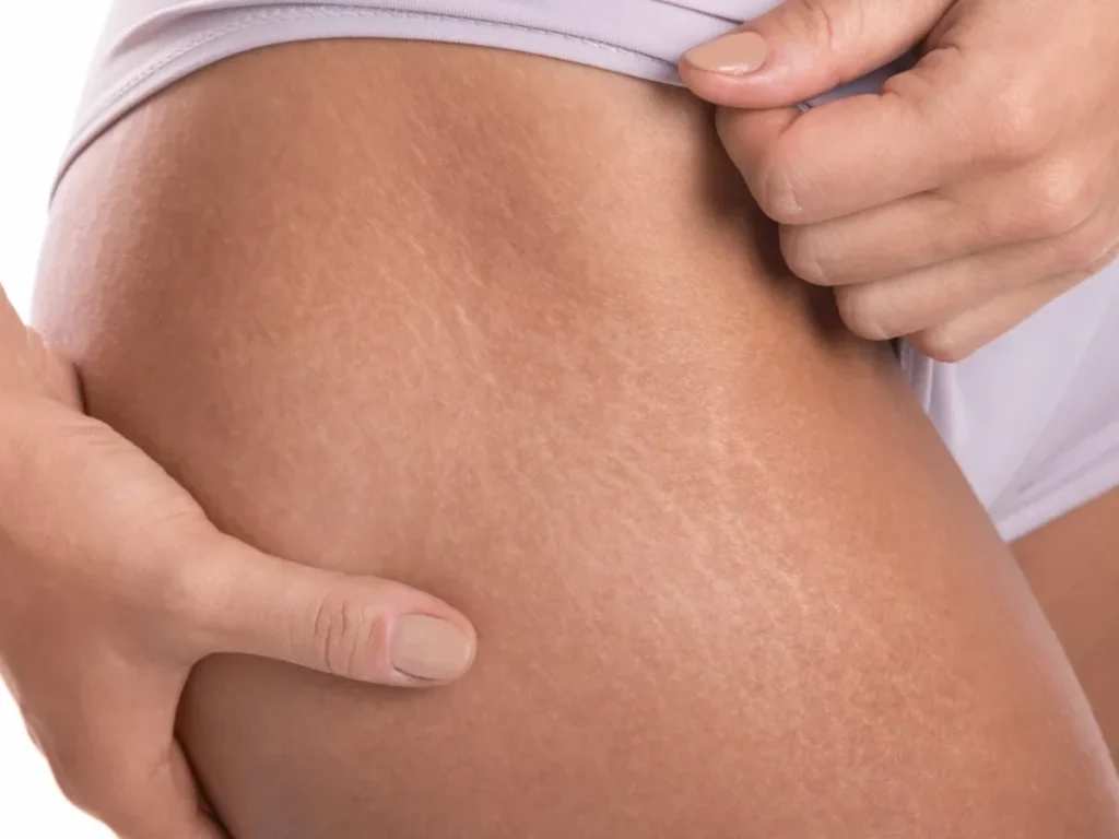 cara menghilangkan stretch mark di wajah