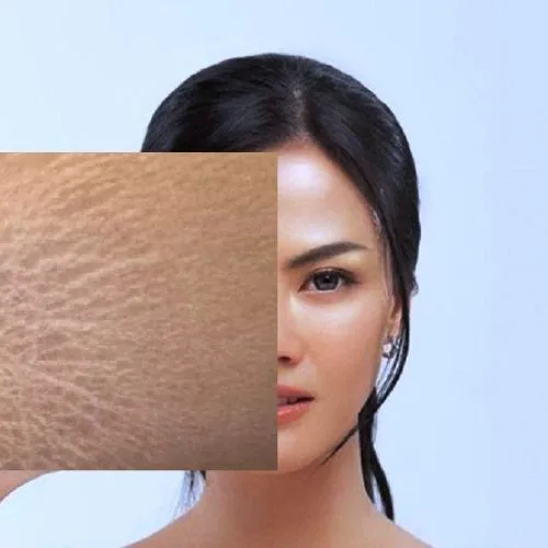 apakah stretch mark bisa hilang dengan sendirinya
