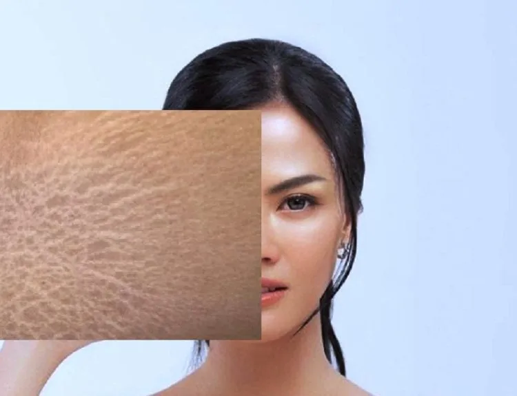 apakah stretch mark bisa hilang dengan sendirinya