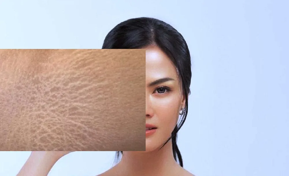 cara menghilangkan stretch mark di wajah